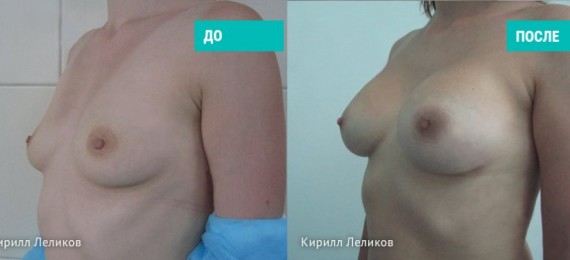 Увеличение груди. Результат после 12 месяцев.