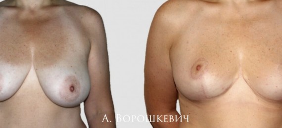 Уменьшение груди. Пациентка 50 лет. Редукционная маммопластика. Фотографии до и через 5 недель после уменьшения груди.